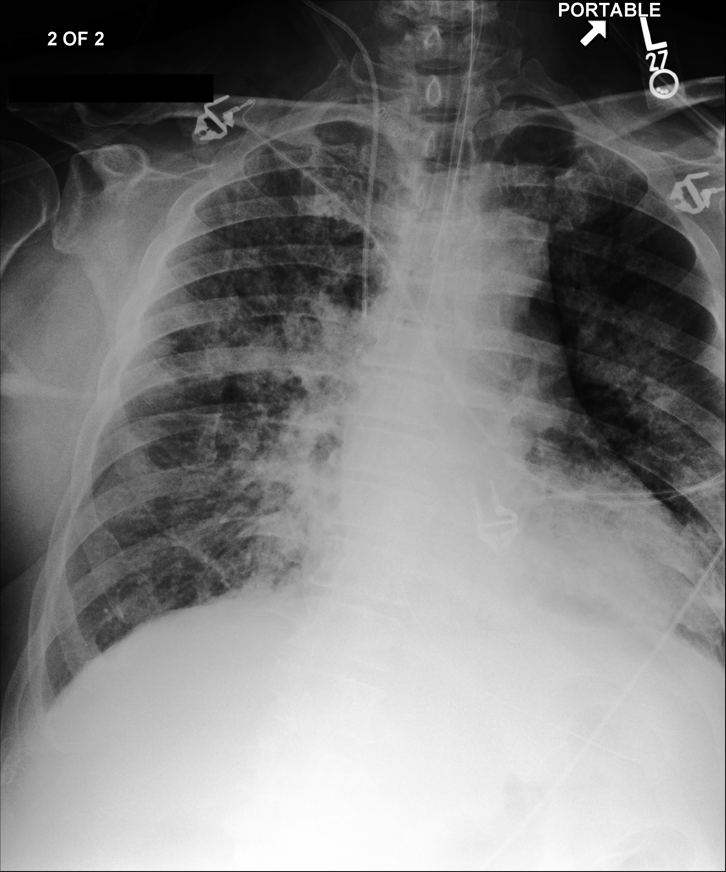 First MIMIC chest X-ray image