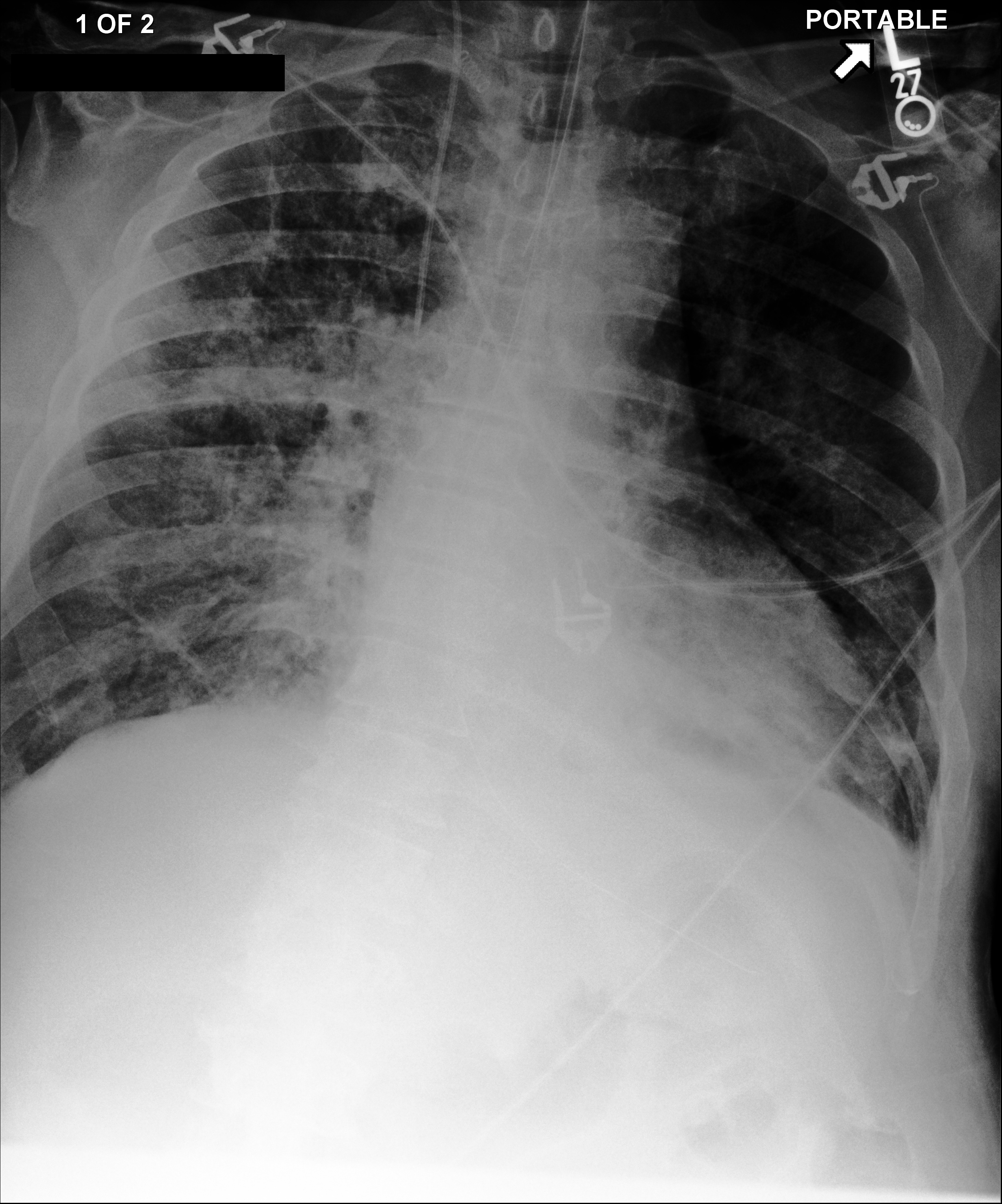 Second MIMIC chest X-ray image
